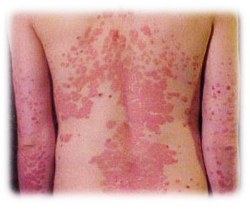 Water allergy symptoms include welts and rashes Water allergy 2